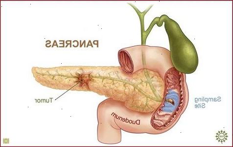 Sådan at lære om kræft i bugspytkirtlen diagnose proces. Bugspytkirtlen er en meget speciel organ i kroppen.