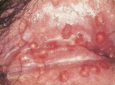 Skeden herpes i Infektioner i